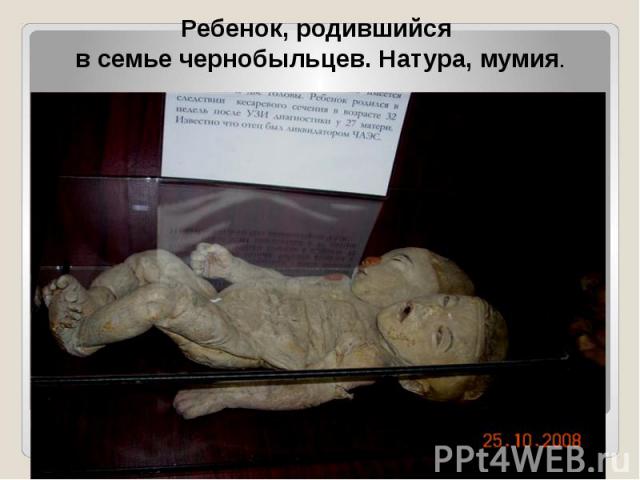 Ребенок, родившийся в семье чернобыльцев. Натура, мумия.