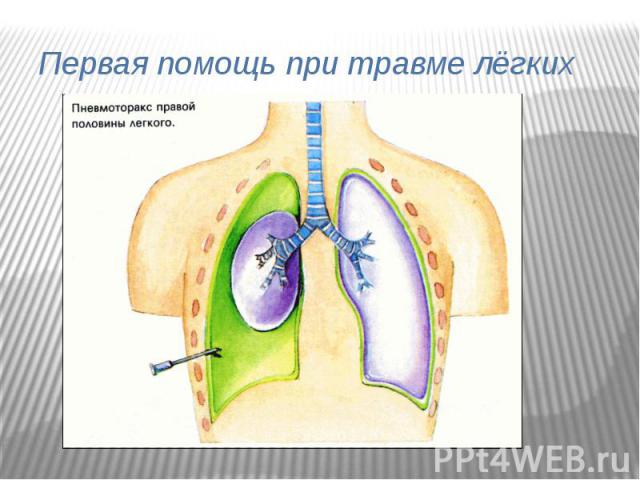 Первая помощь при травме лёгких