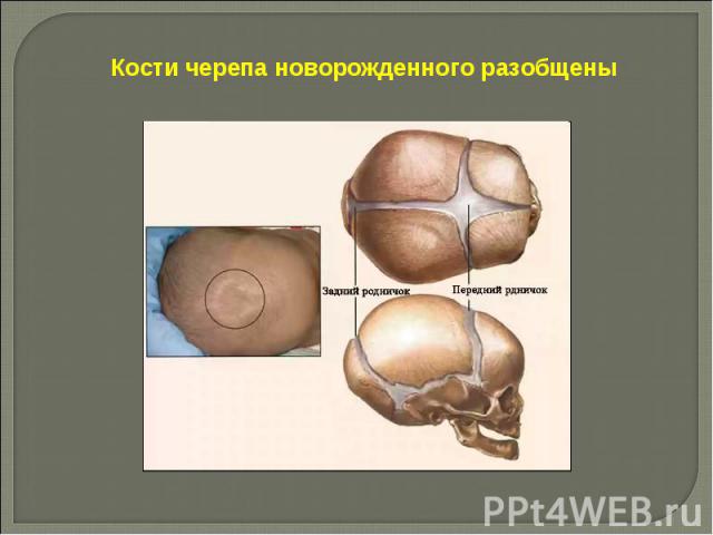 Кости черепа новорожденного разобщены