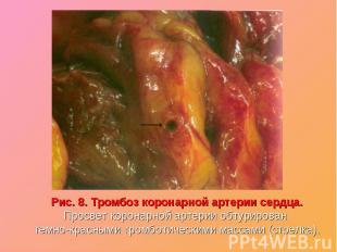 Рис. 8. Тромбоз коронарной артерии сердца.Рис. 8. Тромбоз коронарной артерии сер