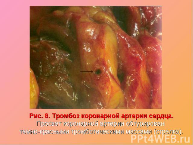 Рис. 8. Тромбоз коронарной артерии сердца.Рис. 8. Тромбоз коронарной артерии сердца.Просвет коронарной артерии обтурирован темно-красными тромботическими массами (стрелка).