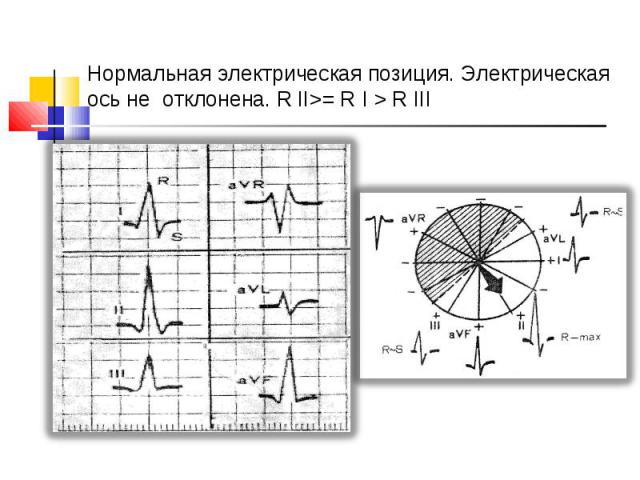 Нормальная электрическая позиция. Электрическая ось не отклонена. R ІІ>= R І > R ІІІ