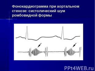Фонокардиограмма при аортальном стенозе: систолический шум ромбовидной формы
