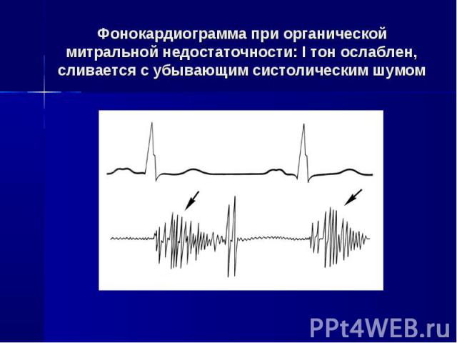 Аускультативная картина митральной недостаточности тест с ответами