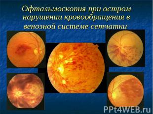 Офтальмоскопия при остром нарушении кровообращения в венозной системе сетчатки