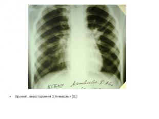 Бронхит, левосторонняя D1 пневмония (S 3 )