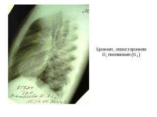Бронхит, левосторонняя D1 пневмония (S 3 )