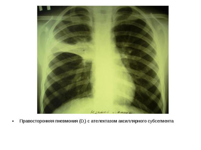 Правосторонняя пневмония (D1) с ателектазом аксиллярного субсегмента