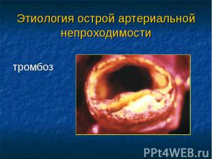 Этиология острой артериальной непроходимости тромбоз