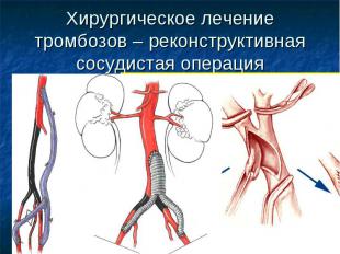 Хирургическое лечение тромбозов – реконструктивная сосудистая операция