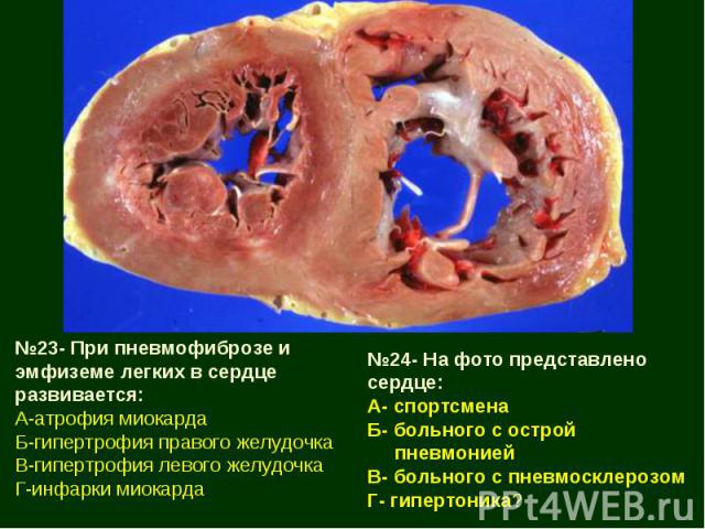 №23- При пневмофиброзе и эмфиземе легких в сердце развивается: А-атрофия миокарда Б-гипертрофия правого желудочка В-гипертрофия левого желудочка Г-инфарки миокарда №24- На фото представлено сердце: А- спортсмена Б- больного с острой пневмонией В- бо…