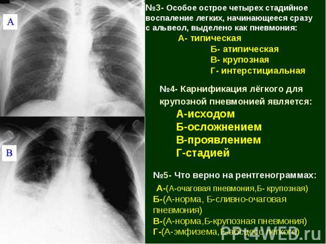 №3- Особое острое четырех стадийное воспаление легких, начинающееся сразу с альвеол, выделено как пневмония: А- типическая Б- атипическая В- крупозная Г- интерстициальная №4- Карнификация лёгкого для крупозной пневмонией является: А-исходом Б-осложн…