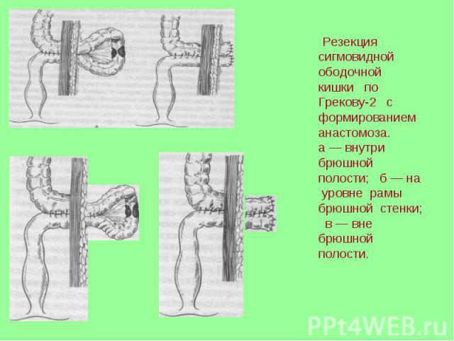Резекция сигмовидной ободочной кишки по Грекову-2 с формированием анастомоза. а — внутри брюшной полости; б — на уровне рамы брюшной стенки; в — вне брюшной полости.