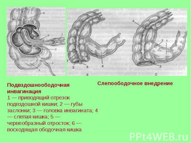Подвздошноободочная инвагинация 1 — приводящий отрезок подвздошной кишки; 2 — губы заслонки; 3 — головка инвагината; 4 — слепая кишка; 5 — червеобразный отросток; 6 — восходящая ободочная кишка Слепоободочное внедрение