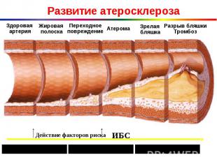 Развитие атеросклероза Здоровая артерия Жировая полоска Переходное повреждение А