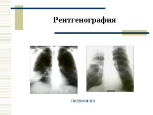 Рентгенография пневмония