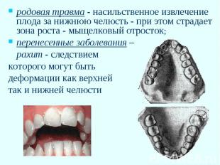 родовая травма - насильственное извлечение плода за нижнюю челюсть - при этом ст