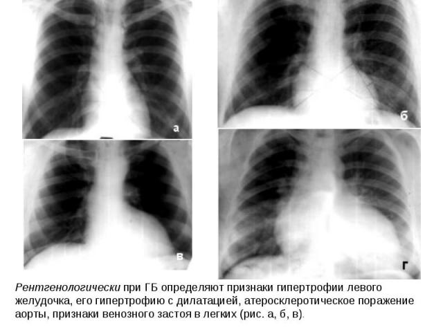 Рентгенологически при ГБ определяют признаки гипертрофии левого желудочка, его гипертрофию с дилатацией, атеросклеротическое поражение аорты, признаки венозного застоя в легких (рис. а, б, в).