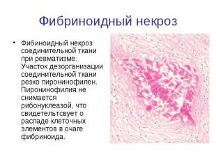 Фибриноидный некроз Фибиноидный некроз соединительной ткани при ревматизме. Учас