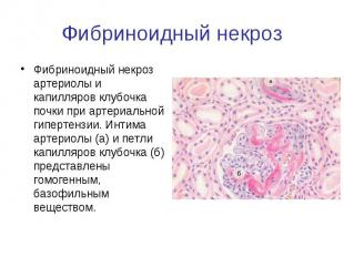 Фибриноидный некроз Фибриноидный некроз артериолы и капилляров клубочка почки пр