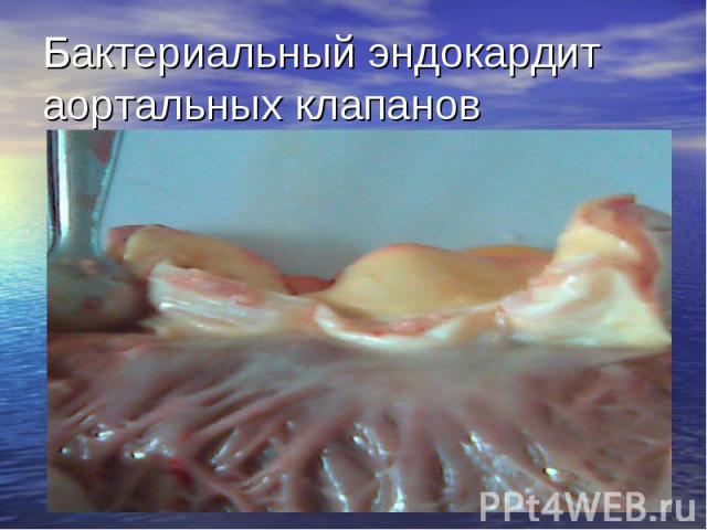 Бактериальный эндокардит аортальных клапанов