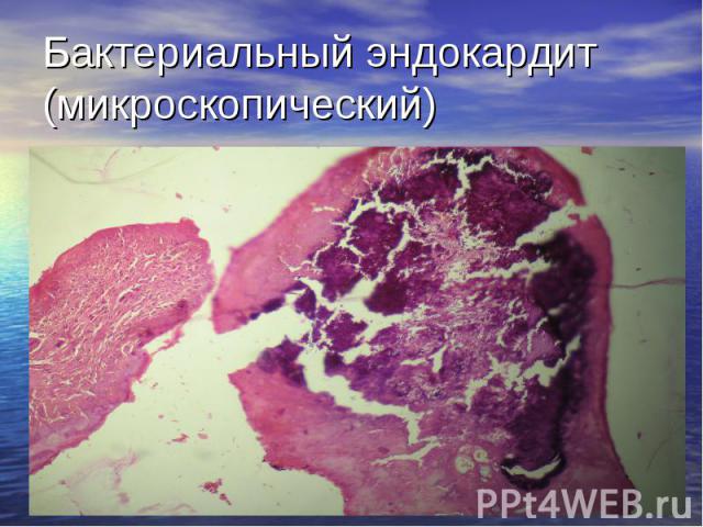 Бактериальный эндокардит (микроскопический)