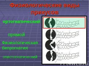 Физиологические виды прикусов прямой ортогнатический Физиологическая бипрогнатия