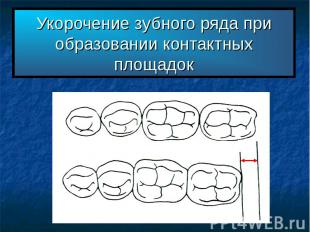 Укорочение зубного ряда при образовании контактных площадок