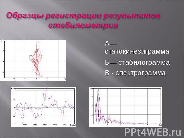 А— статокинезиграмма Б— стабилограмма В - спектрограмма