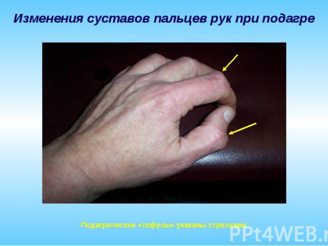 Изменения суставов пальцев рук при подагре Подагрические «тофусы» указаны стрелками