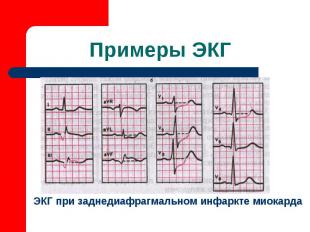 ЭКГ при заднедиафрагмальном инфаркте миокарда Примеры ЭКГ