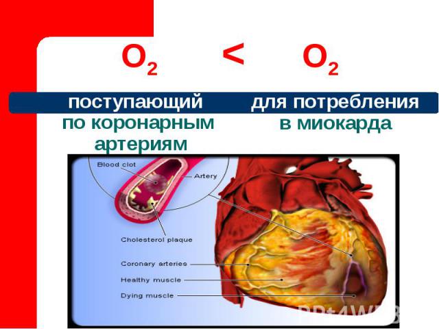 О2 < О2 для потребления в миокарда поступающий по коронарным артериям