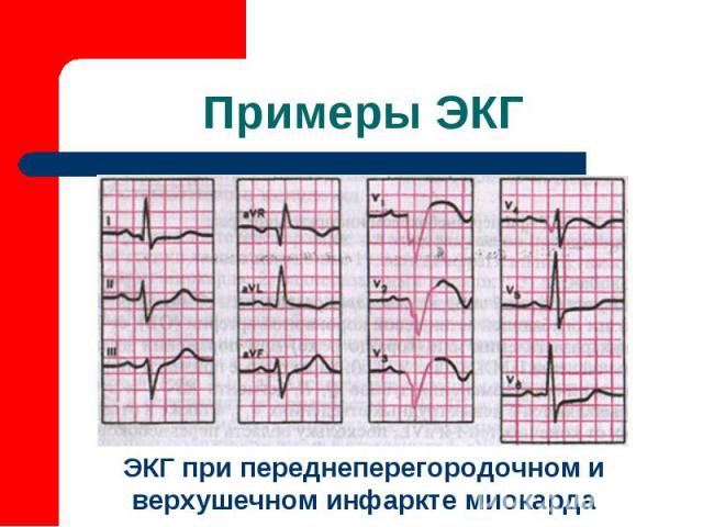 ЭКГ при переднеперегородочном и верхушечном инфаркте миокарда Примеры ЭКГ