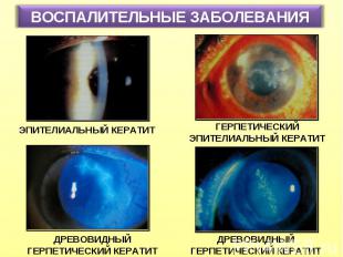 ВОСПАЛИТЕЛЬНЫЕ ЗАБОЛЕВАНИЯ ЭПИТЕЛИАЛЬНЫЙ КЕРАТИТ ГЕРПЕТИЧЕСКИЙ ЭПИТЕЛИАЛЬНЫЙ КЕР