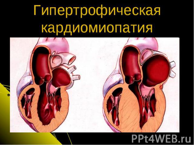 Гипертрофическая кардиомиопатия