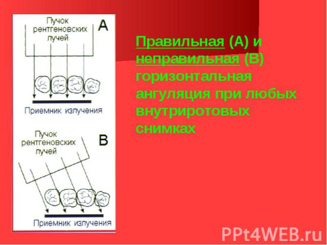 Правильная (А) и неправильная (В) горизонтальная ангуляция при любых внутриротовых снимках