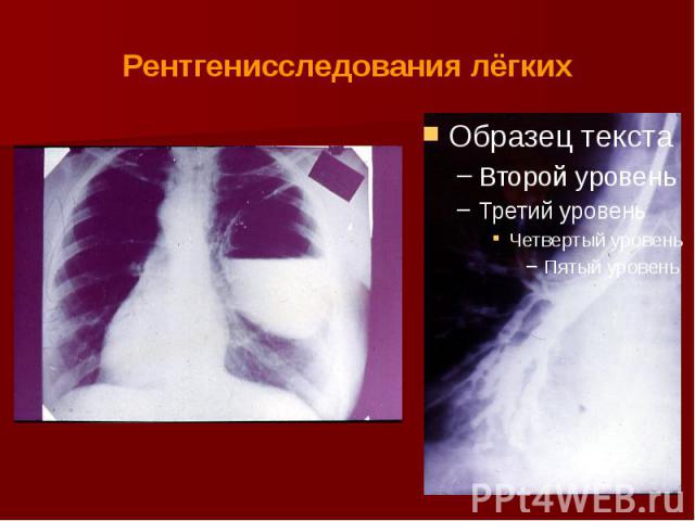 Рентгенисследования лёгких