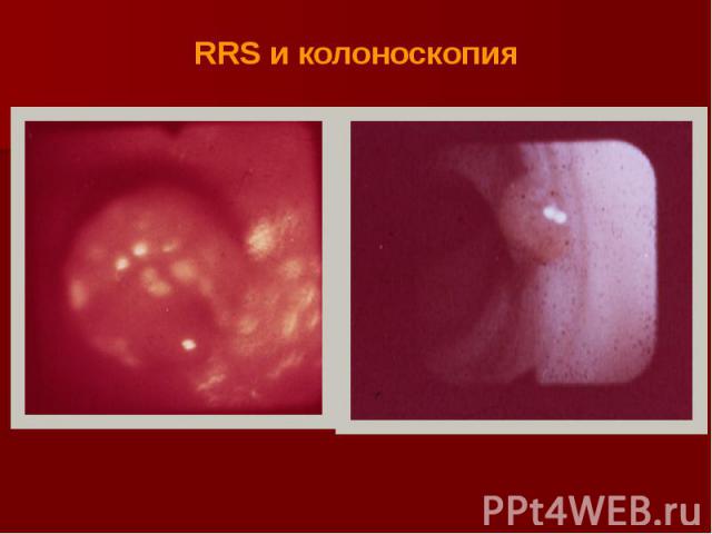 RRS и колоноскопия