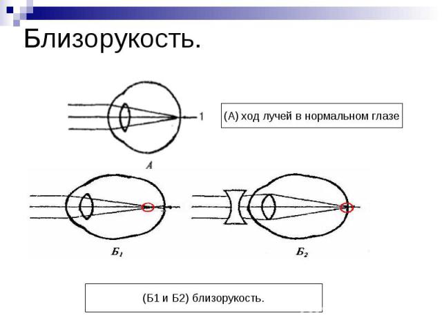 Близорукость. (А) ход лучей в нормальном глазе(Б1 и Б2) близорукость.