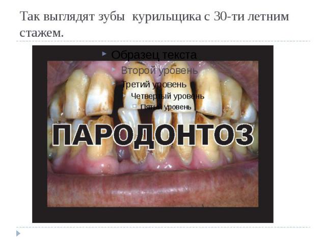 Так выглядят зубы курильщика с 30-ти летним стажем.