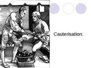 Cauterisation: