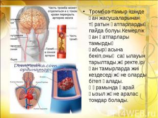 Тромбоз-тамыр ішінде қан жасушаларынан тұратын қатпарлардың пайда болуы.Кемерлік