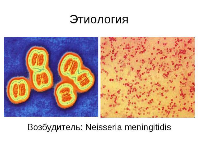 Этиология Возбудитель: Neisseria meningitidis