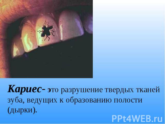 Кариес- это разрушение твердых тканей зуба, ведущих к образованию полости (дырки).