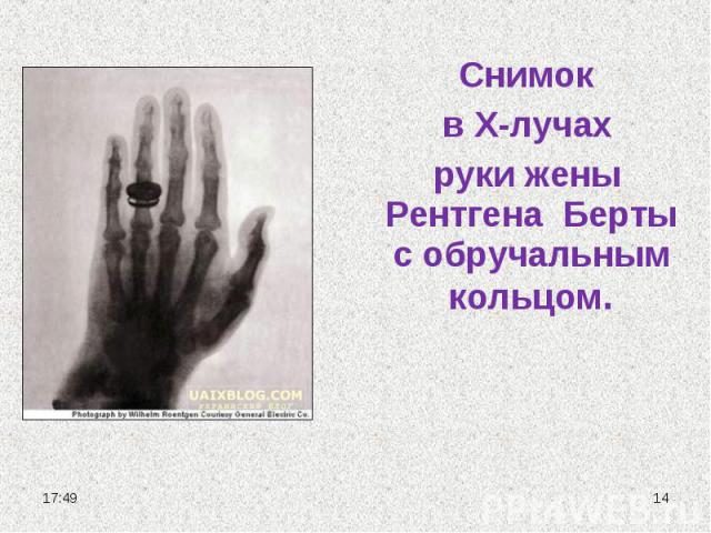 Снимок в Х-лучах руки жены Рентгена Берты с обручальным кольцом.