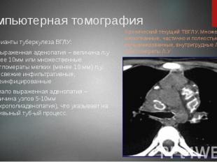 Компьютерная томография Варианты туберкулеза ВГЛУ: 1) выраженная аденопатия – ве