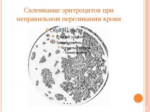 Склеивание эритроцитов при неправильном переливании крови