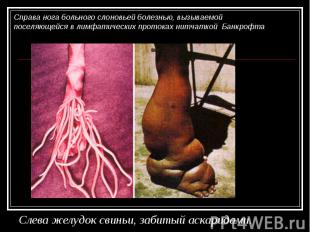 Справа нога больного слоновьей болезнью, вызываемой поселяющейся в лимфатических