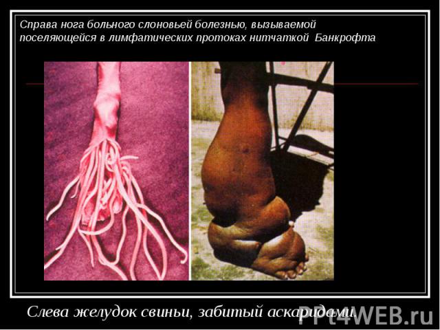Справа нога больного слоновьей болезнью, вызываемой поселяющейся в лимфатических протоках нитчаткой Банкрофта Слева желудок свиньи, забитый аскаридами.