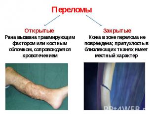 Переломы Открытые Рана вызвана травмирующим фактором или костным обломком, сопро